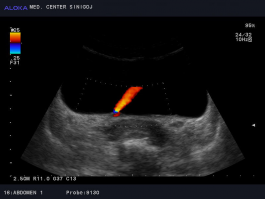 Ultrazvok mehurja - normalen jet urina iz desnega ostija